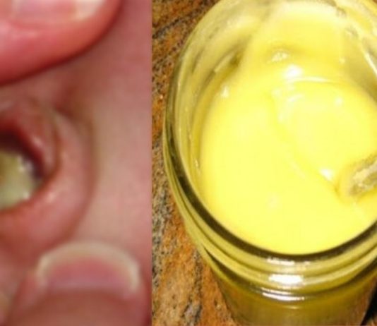 უძლიერესი სამკურნალო საშუალება, რომელსაც ორგანიზმიდან გამოაქვს ჩირქი