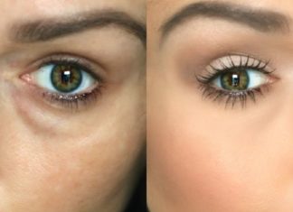 შეშუპებული და ჩაშავებული კანი თვალების ირგვლივ შეგიძლიათ ამ მარტივი ინგრედიენტების გამოყენებით სამუდამოდ დაივიწყოთ