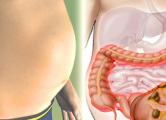 ხალხური საშუალებები მეტეორიზმის წინააღმდეგ. ამ რეცეპტის ინგრედიენტები ყველას სამზარეულოში მოიპოვება