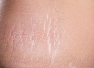 სტრიების მოცილება სახლის პირობებში როგორც იქნა შესაძლებელი გახდა.