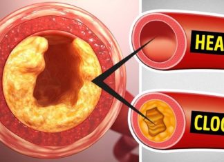 Ნუ დახარჯავთ ზედმეტ ფულს წამლებში ქოლესტერინისა და სისხლის წნევის კონტროლისთვის – შეეცადეთ გამოიყენოთ ეს საშუალება 7 დღის განმავლობაში!