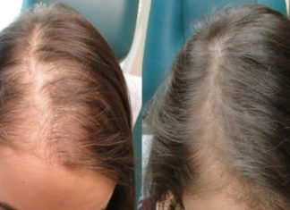 თუ გსურთ თქვენმა თმამ ცვენა შეწყვოტოს, გამოიყენეთ ამ 1 ინგრედიენტით დამზადებული ნიღაბი.