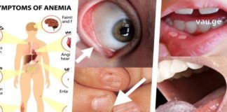 იცით, როდის არის რკინის ნაკლებობა ორგანიზმში?! რა უნდა მოიმოქმედოთ ამ დროს?!