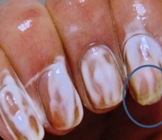 აი, რა ეფექტი ექნება სოდას თუ ფრჩხილებზე წაისვამთ. ამის შემდეგ ასე ხშირად მოიქცევით