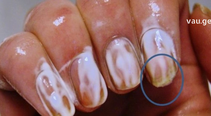 აი, რა ეფექტი ექნება სოდას თუ ფრჩხილებზე წაისვამთ. ამის შემდეგ ასე ხშირად მოიქცევით