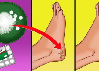 ეს წამალი დახეთქილი ქუსლების პრობლემას მხოლოდ 10 დღეში მოგაშორებთ