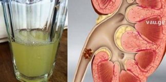 ხალხური მეთოდი თირკმელებიდან კენჭების გამოსადევნად, რომლებიც წლების წინ გამოსცადეს ჩვენმა წინაპრებმა