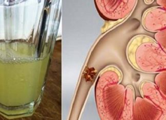 ხალხური მეთოდი თირკმელებიდან კენჭების გამოსადევნად, რომლებიც წლების წინ გამოსცადეს ჩვენმა წინაპრებმა