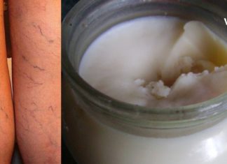 ვარიკოზი არასდროს შეგაწუხებთ, 50 წელს რომ გადაცდებით მაშინაც კი, თუ ყოველ საღამოს მიიღებთ ამ წამალს.