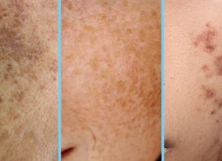 როგორ ვებრძოლოთ კანის ჰიპერპიგმენტაციას სახლის პირობებში? წაიკითხეთ ეს სტატია