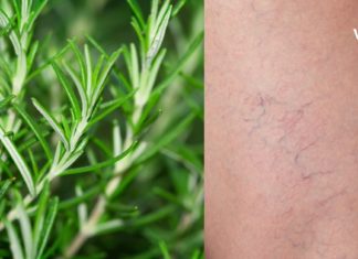 როზმარინის და სპირტის ნაყენი სამუდამოდ გაგიქრობთ ვარიკოზულ ვენებს. ნახეთ როგორ უნდა მოამზადოთ ის