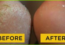 არ იცით თავი როგორ დააღწიოთ დახეთქილ ქუსლებს? ბევრი მეთოდი სცადეთ უშედეგოდ? მაშინ ეს სტატია თქვენთვისაა