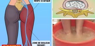 იშიაზის მკუშნალობა ხალხური მეთოდით ყველაზე ეფექტურია