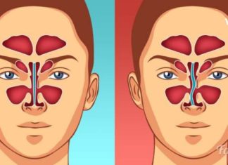 დააღწიეთ თავი მტანჯველ ჰაიმორტის! ეს რეცეპტი დაგეხმარებათ განკურნებაში