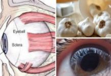 აღიდგინეთ მხედველობა ნიორის დახმარებით. არანაირი ოპერაცია!