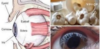 აღიდგინეთ მხედველობა ნიორის დახმარებით. არანაირი ოპერაცია!