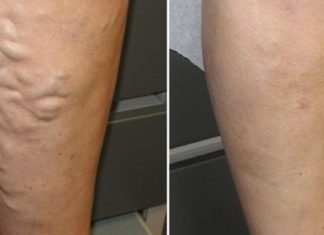 გაინტერესებთ როგორ უნდა უმკურნალოთ ვარიკოზულ ვენებს სახლის პირობებში? მე ამ რჩევებით მივიღე ეს შედეგი