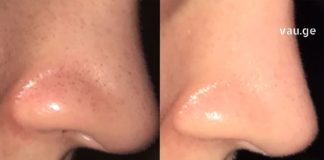 3 რეცეპტი, რომლებიც შავ წერტილებს წამებში აქრობს! დაივიწყეთ ეს მტანჯველი პრობლემა სამუდამოდ.