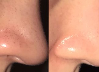 3 რეცეპტი, რომლებიც შავ წერტილებს წამებში აქრობს! დაივიწყეთ ეს მტანჯველი პრობლემა სამუდამოდ.