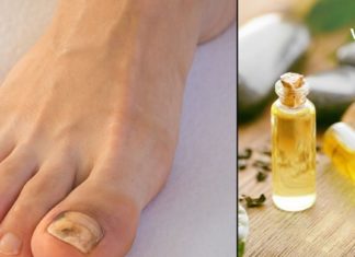 ხალხური მეთოდები ფრჩხილის სოკოს სამკურნალოდ. შედეგი გარანტირებულია!