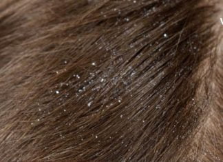 გათავისუფლდით არასასურველი ქერტლისგან ამ მეთოდით