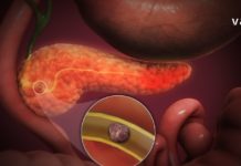 სასწრაფო დამხმარე საშუალებები პანკრეასის დროს, რომელთა დამზადება შეგიძლიათ სახლში