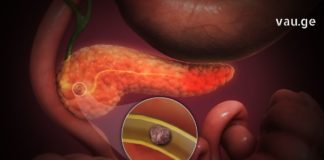 სასწრაფო დამხმარე საშუალებები პანკრეასის დროს, რომელთა დამზადება შეგიძლიათ სახლში