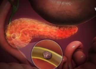 სასწრაფო დამხმარე საშუალებები პანკრეასის დროს, რომელთა დამზადება შეგიძლიათ სახლში