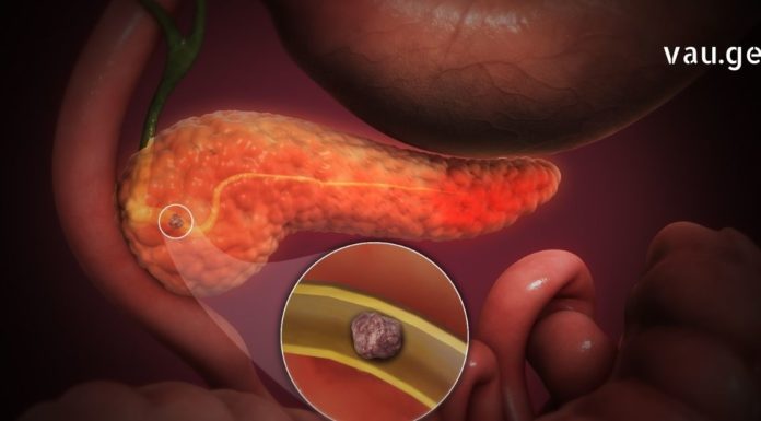 სასწრაფო დამხმარე საშუალებები პანკრეასის დროს, რომელთა დამზადება შეგიძლიათ სახლში