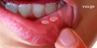 ამ მარტივი და იაფი მეთოდით მოვიცილე სტომატიტი სახლის პირობებში. ეს შესაძლებელია