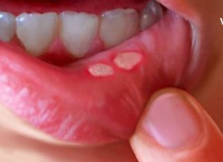 ამ მარტივი და იაფი მეთოდით მოვიცილე სტომატიტი სახლის პირობებში. ეს შესაძლებელია