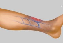 სისხლის Ცუდი მიმოქცევის 4 მნიშვნელოვანი ნიშანი, რომელიც არ უნდა გამოტოვოთ! ეს არის თქვენი ჯანმრთელობისთვის ძალიან მნიშვნელოვანი