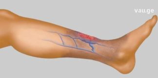 სისხლის Ცუდი მიმოქცევის 4 მნიშვნელოვანი ნიშანი, რომელიც არ უნდა გამოტოვოთ! ეს არის თქვენი ჯანმრთელობისთვის ძალიან მნიშვნელოვანი