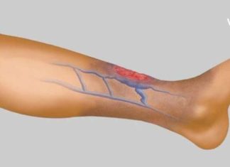 სისხლის Ცუდი მიმოქცევის 4 მნიშვნელოვანი ნიშანი, რომელიც არ უნდა გამოტოვოთ! ეს არის თქვენი ჯანმრთელობისთვის ძალიან მნიშვნელოვანი