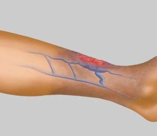 სისხლის Ცუდი მიმოქცევის 4 მნიშვნელოვანი ნიშანი, რომელიც არ უნდა გამოტოვოთ! ეს არის თქვენი ჯანმრთელობისთვის ძალიან მნიშვნელოვანი