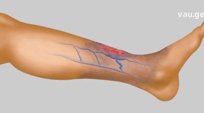 სისხლის Ცუდი მიმოქცევის 4 მნიშვნელოვანი ნიშანი, რომელიც არ უნდა გამოტოვოთ! ეს არის თქვენი ჯანმრთელობისთვის ძალიან მნიშვნელოვანი