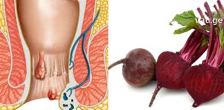 ვისაც ბუასილი აწუხებს, კარგად იცის ამ ტანჯვის შესახებ. ჩვენ გთავაზობთ უსწრაფეს მეთოდს