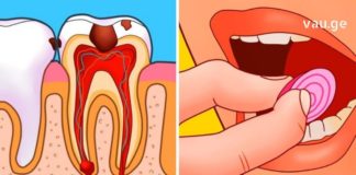 როგორ დავიცხროთ კბილის მტანჯველი ტკივილი სახლის პირობებში