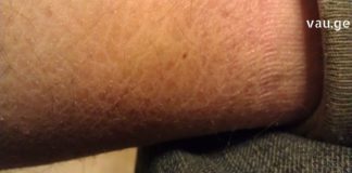 ჩემმა მეგობარმა იქთიოზის მკურნალობა ამ სასწაული რეცეპტის წყალობით შეძლო