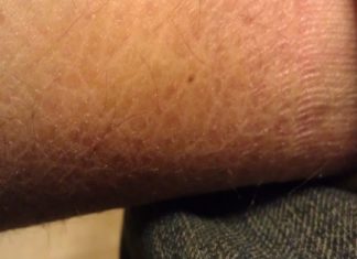 ჩემმა მეგობარმა იქთიოზის მკურნალობა ამ სასწაული რეცეპტის წყალობით შეძლო