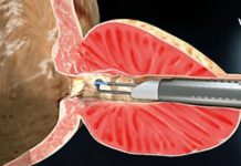 ბაბუაჩემს წლების წინ პროსტატის ადენომა დაუდგინდა. ბევრი მკურნალობის შემდეგ, ხალხურ რეცეპტებს მიაგნობდა თავიც გადაირჩნა