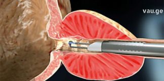 ბაბუაჩემს წლების წინ პროსტატის ადენომა დაუდგინდა. ბევრი მკურნალობის შემდეგ, ხალხურ რეცეპტებს მიაგნობდა თავიც გადაირჩნა