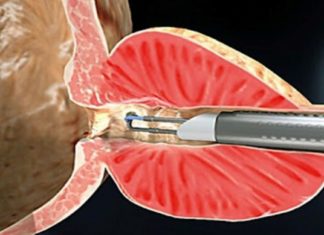 ბაბუაჩემს წლების წინ პროსტატის ადენომა დაუდგინდა. ბევრი მკურნალობის შემდეგ, ხალხურ რეცეპტებს მიაგნობდა თავიც გადაირჩნა