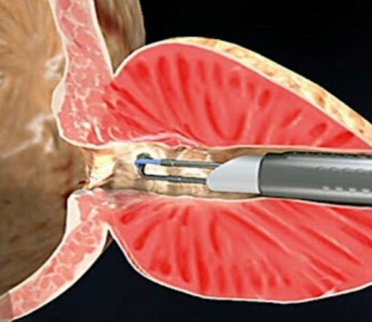 ბაბუაჩემს წლების წინ პროსტატის ადენომა დაუდგინდა. ბევრი მკურნალობის შემდეგ, ხალხურ რეცეპტებს მიაგნობდა თავიც გადაირჩნა