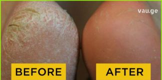 47 წლის ქალი ვარ და მხოლოდ ახლა მოვახერხე ამ დისკომფორტის დაძლევა – ხალხური მედიცინის წარმატებული რეცეპტები