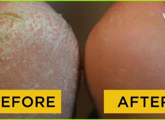 47 წლის ქალი ვარ და მხოლოდ ახლა მოვახერხე ამ დისკომფორტის დაძლევა – ხალხური მედიცინის წარმატებული რეცეპტები