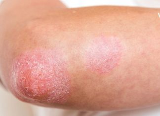 როგორ განვიკურნე ფსორიაზისგან- გაგიზიარებთ საკუთარ წარმატებულ საშუალებებს