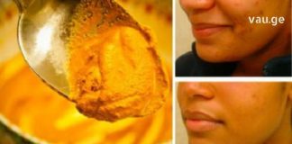 დაიღალეთ აკნესთან ბრძოლით? იცოდით რომ კურკუმა არის ძალიან ეფექტური აკნეს სამკურნალო საშუალება?