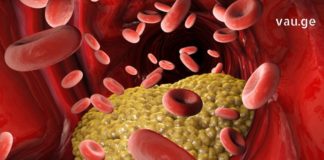 Როგორ განვსაზღვროთ მაღალი ქოლესტერინი სისხლში? რა უნდა გავაკეთოთ იმისათვის რომ ნორმაში იყოს მუდამ?!