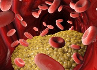 Როგორ განვსაზღვროთ მაღალი ქოლესტერინი სისხლში? რა უნდა გავაკეთოთ იმისათვის რომ ნორმაში იყოს მუდამ?!